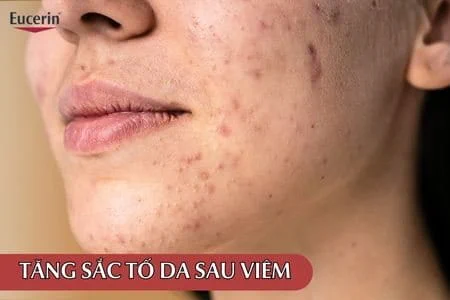 tăng sắc tố sau mụn - Image 2