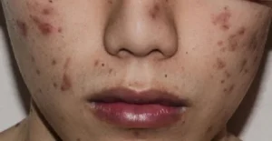 tăng sắc tố sau mụn