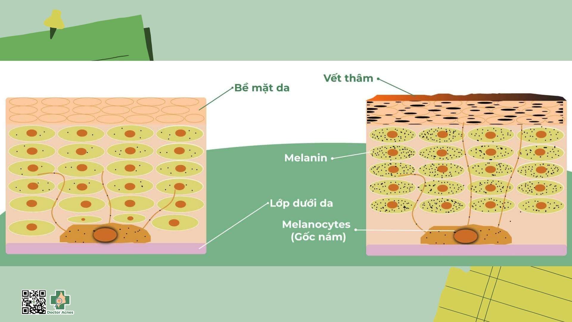 tăng sắc tố sau mụn - Image 4
