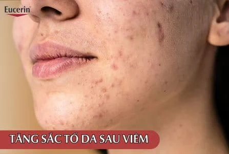 tăng sắc tố sau viêm - Image 3