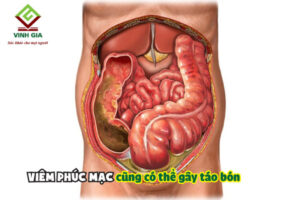 táo bón kèm đau bụng