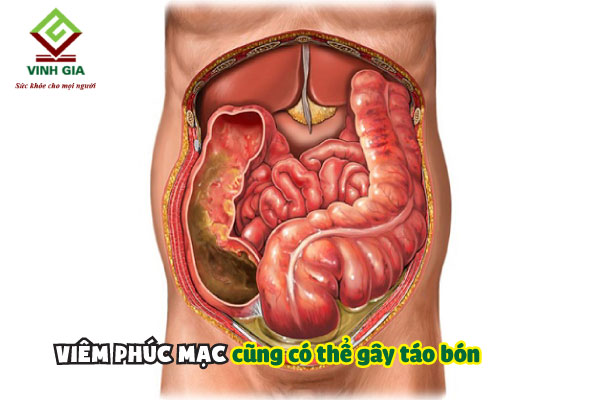 táo bón kèm đau bụng