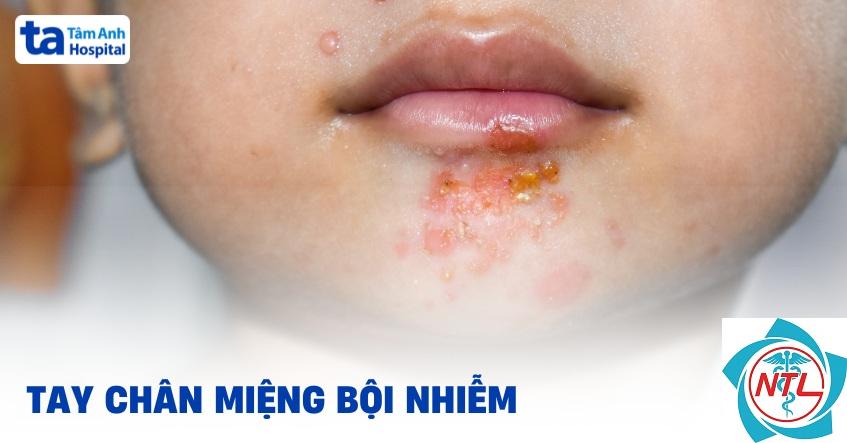 tay chân miệng bội nhiễm da - Image 5