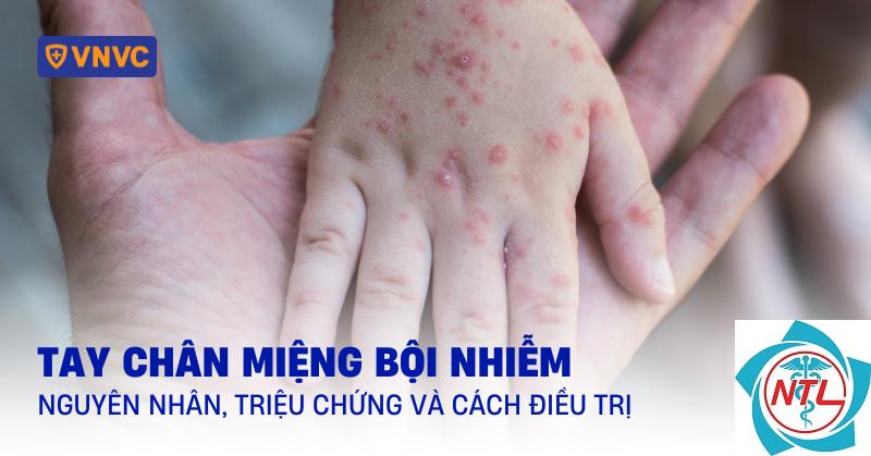tay chân miệng bội nhiễm da