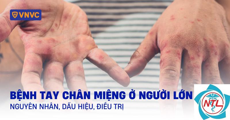 tay chân miệng ở người lớn - Image 3