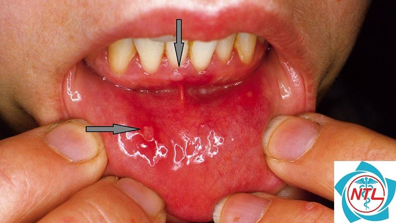 tay chân miệng ở người lớn