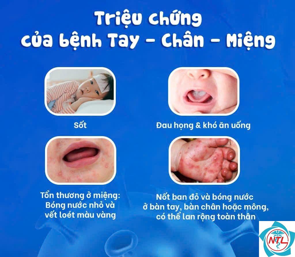 tay chân miệng ở trẻ nhỏ - Image 5