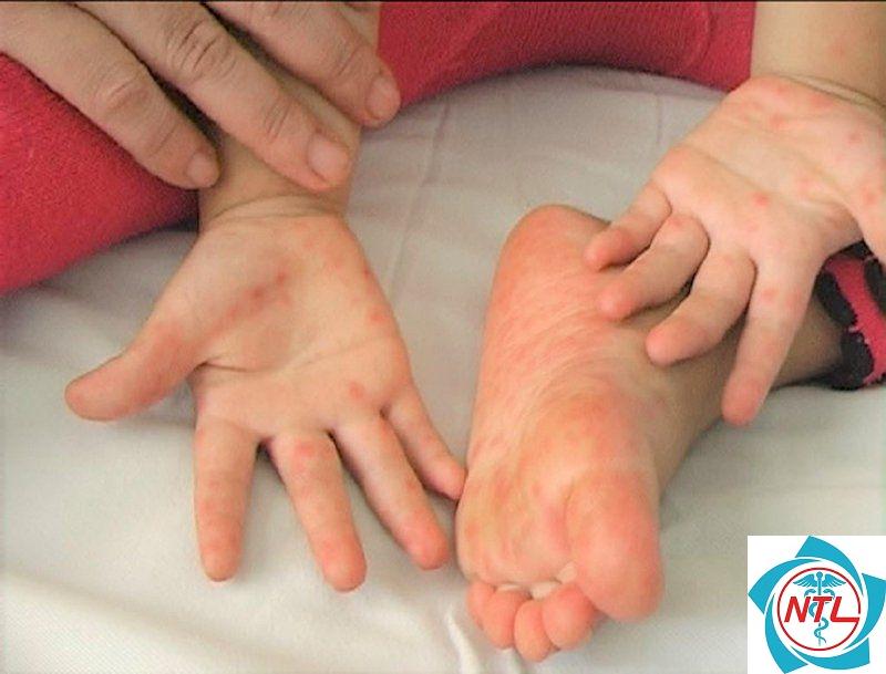 tay chân miệng tái phát