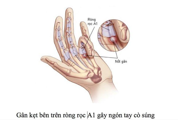 tay không duỗi thẳng được - Image 2