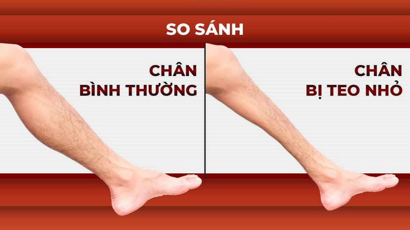 teo cơ có hồi phục được không