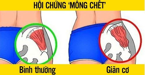 teo cơ mông - Image 3