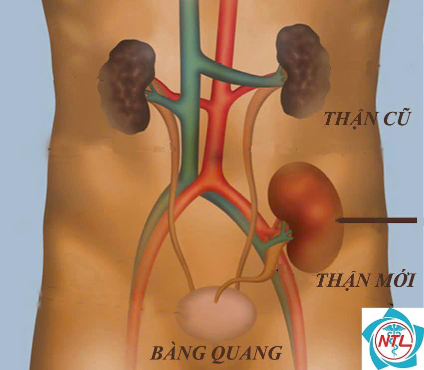 thận ghép - Image 3