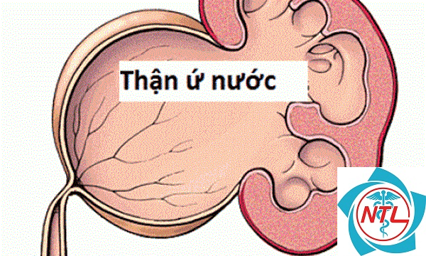 thận ứ nước - Image 2