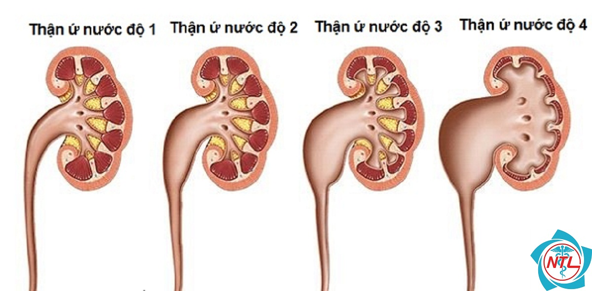 thận ứ nước - Image 3