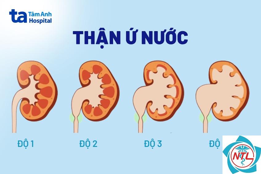 thận ứ nước - Image 5