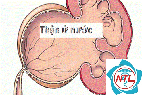 thận ứ nước bẩm sinh - Image 2