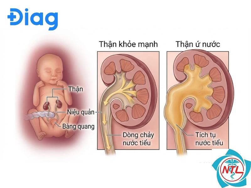 thận ứ nước bẩm sinh - Image 3