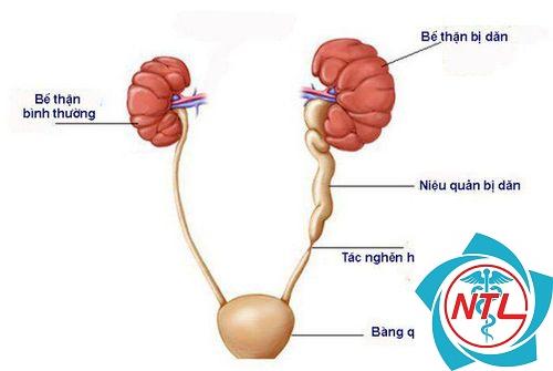 thận ứ nước bẩm sinh - Image 4