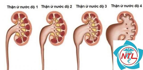 thận ứ nước do sỏi - Image 2