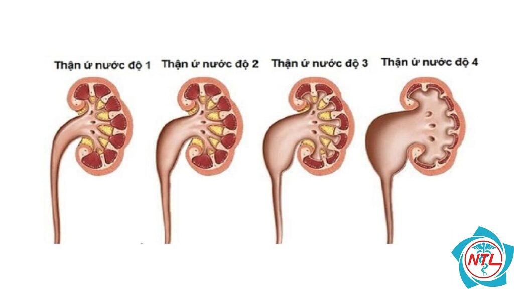 thận ứ nước do tắc nghẽn