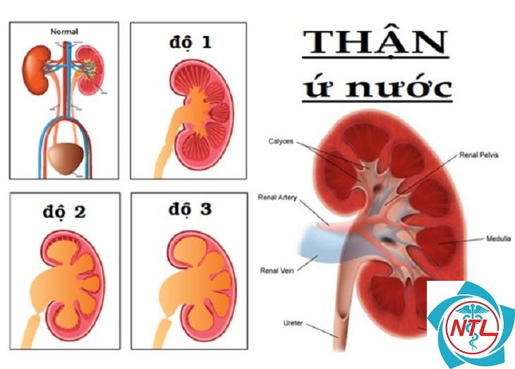 thận ứ nước do tắc nghẽn - Image 2