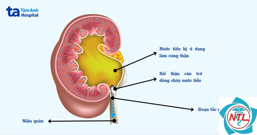 thận ứ nước do tắc nghẽn - Image 4