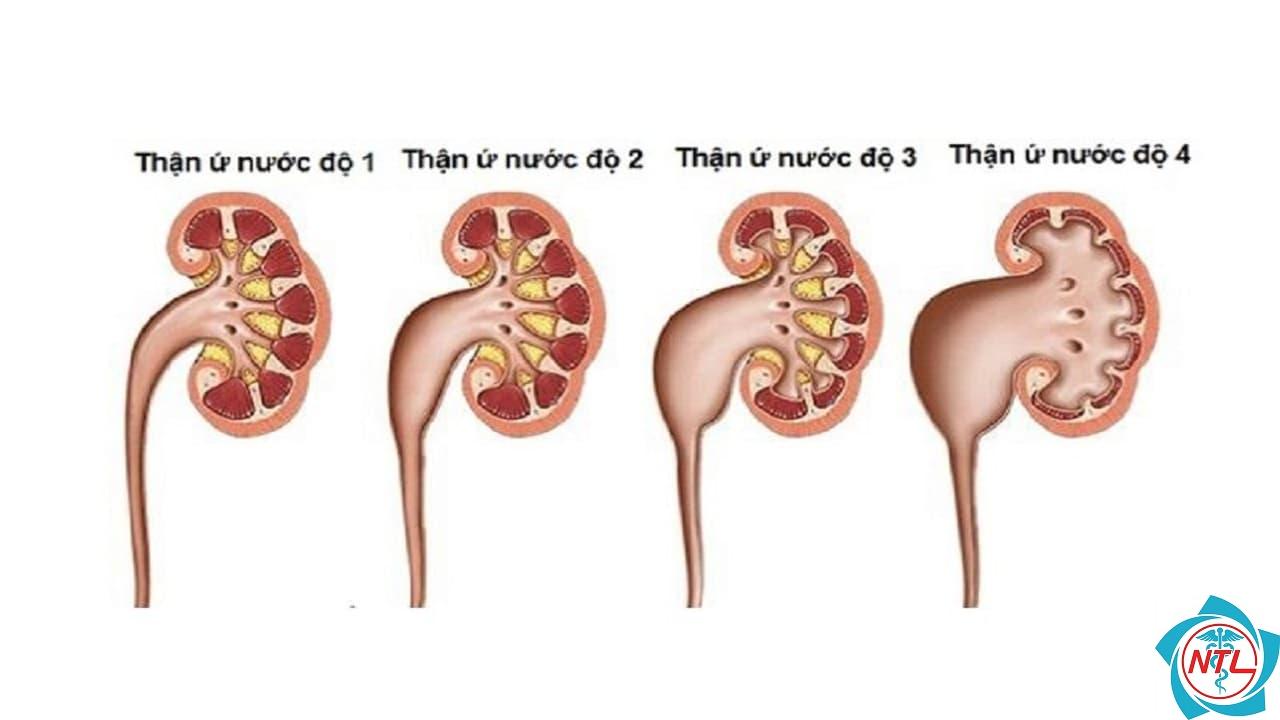 thận ứ nước do tắc nghẽn - Image 1
