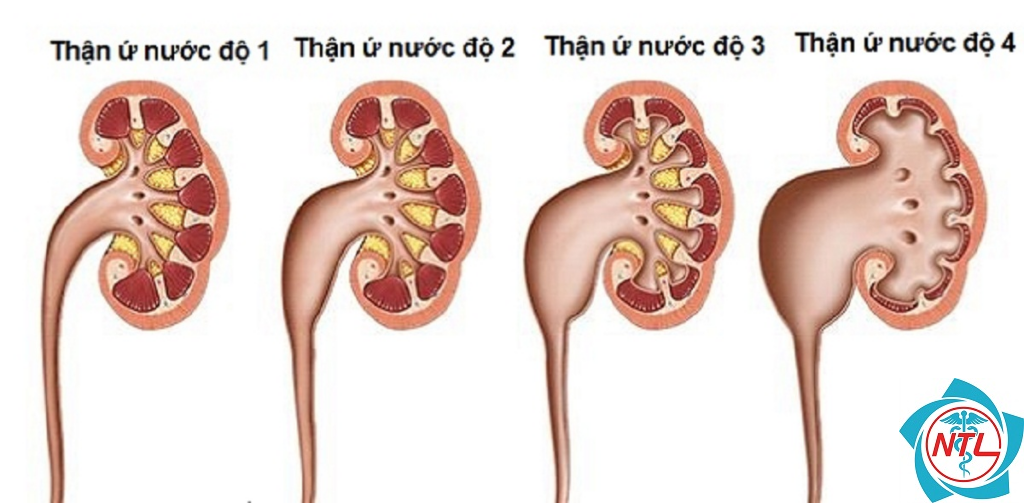 thận ứ nước hai bên