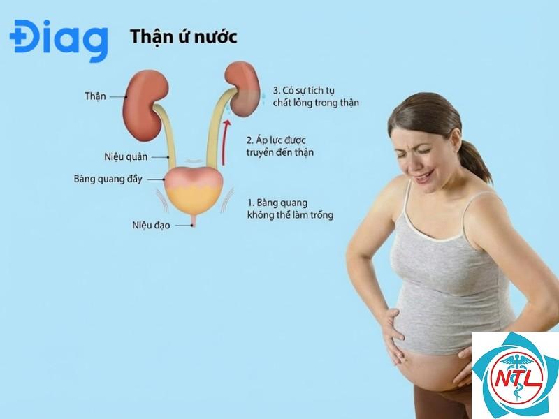thận ứ nước khi mang thai - Image 4