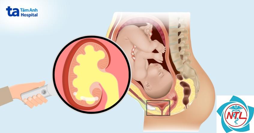 thận ứ nước khi mang thai