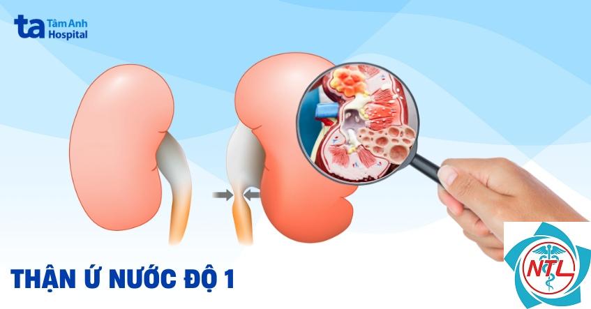 thận ứ nước một bên - Image 2