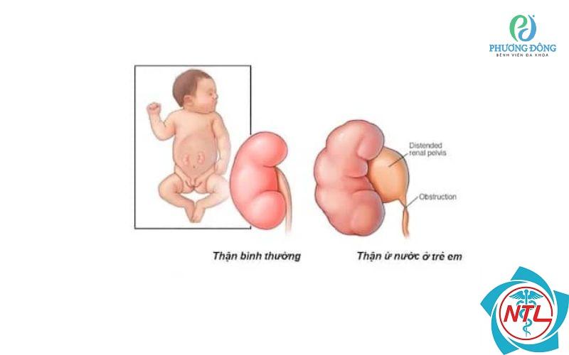 thận ứ nước ở trẻ sơ sinh - Image 4