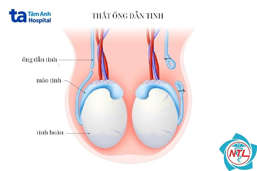 thắt tinh hoàn - Image 4