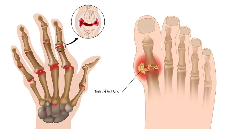 theo dõi acid uric ở người bệnh gout - Image 2