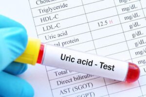 theo dõi acid uric ở người bệnh gout