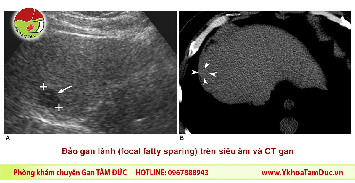 theo dõi gan nhiễm mỡ - Image 2