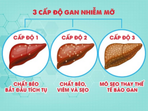 theo dõi gan nhiễm mỡ