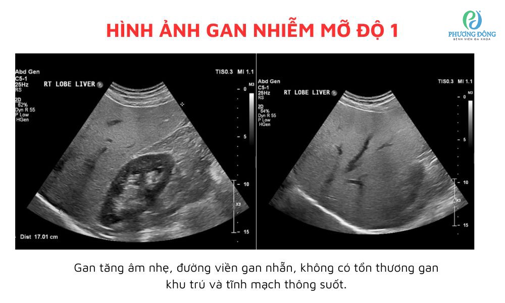 theo dõi gan nhiễm mỡ - Image 5