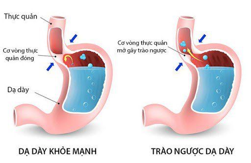 theo dõi trào ngược dạ dày lâu dài - Image 4