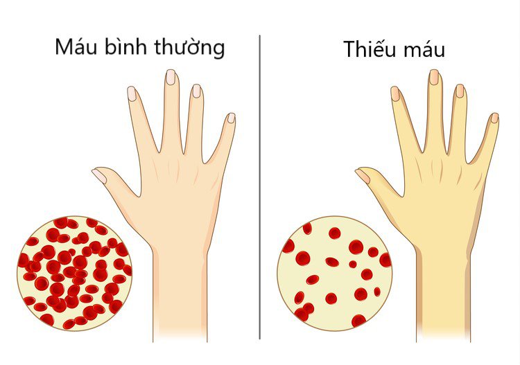 thiếu máu - Image 3