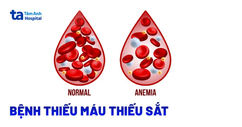 thiếu máu do thiếu sắt ở người lớn - Image 5