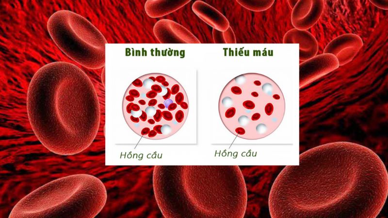 thiếu máu do thiếu vitamin B12 - Image 4