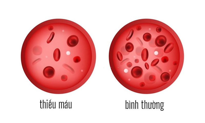 thiếu máu do thiếu vitamin B12 - Image 5