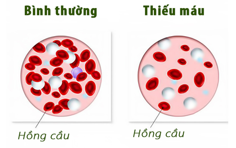 thiếu máu là gì - Image 4