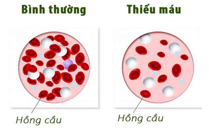 thiếu máu ở người có bệnh mạn tính - Image 3
