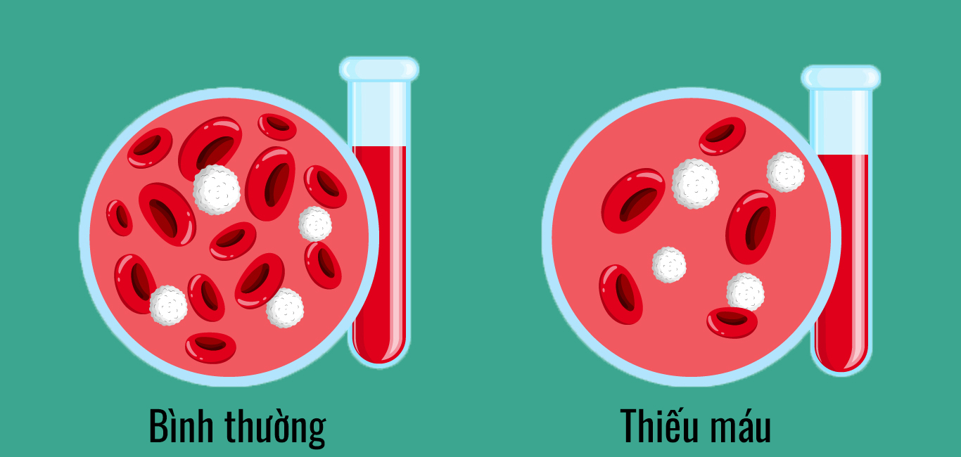 thiếu máu - Image 1