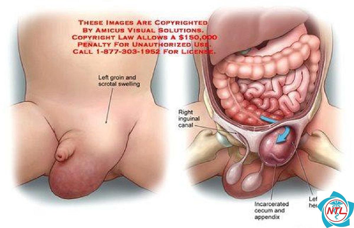 thoát vị bẹn ở trẻ em - Image 3
