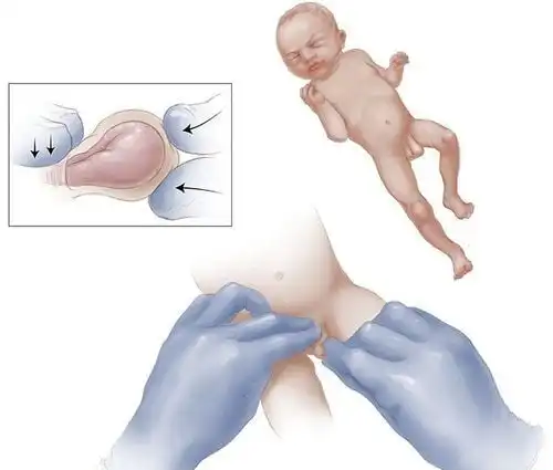 thoát vị bẹn ở trẻ em - Image 5