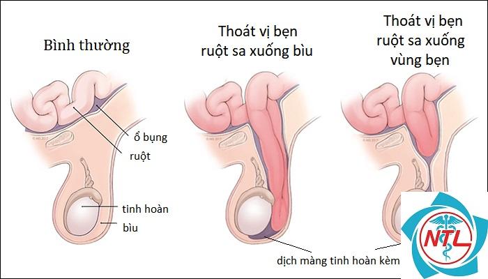 thoát vị bẹn ở trẻ em