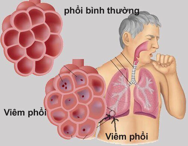 thời gian hồi phục sau viêm phổi - Image 4